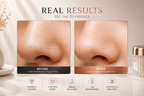 Glowify™ Blackhead Remover Vacuum | Deep Pore Cleaner